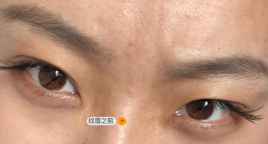 眉毛脱落是什么病