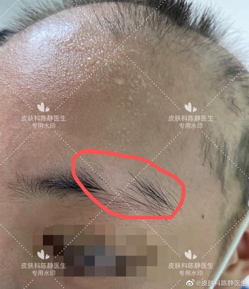 眉毛脱落是什么病