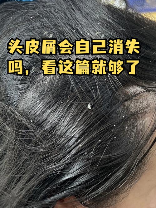 头皮屑多看什么科