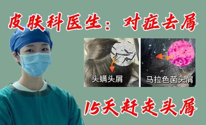 头皮屑多看什么科