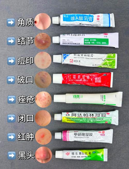 有什么祛痘印的药膏