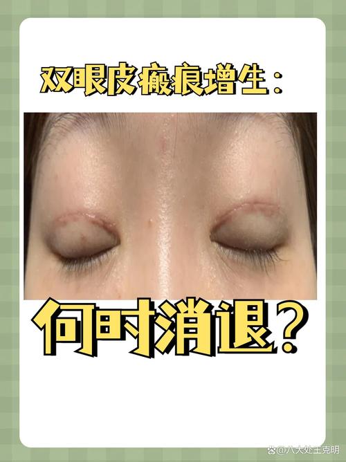 为什么双眼皮会消失