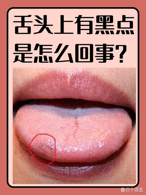 舌苔变黑是什么原因