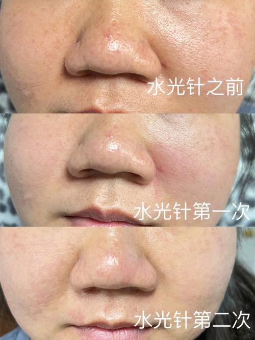 水光针的效果是什么