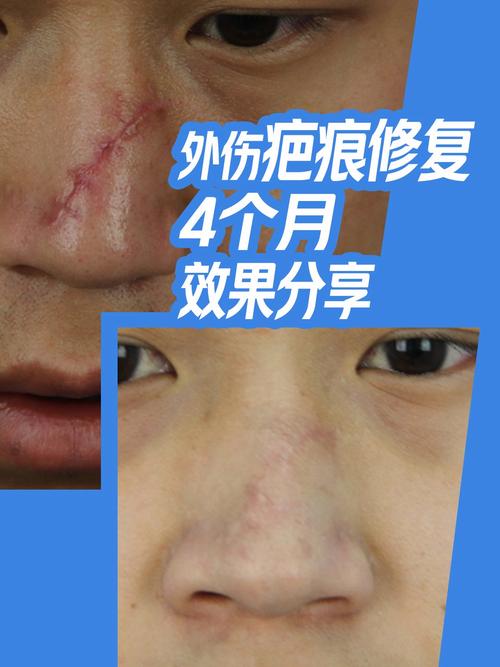 什么修复疤痕比较好