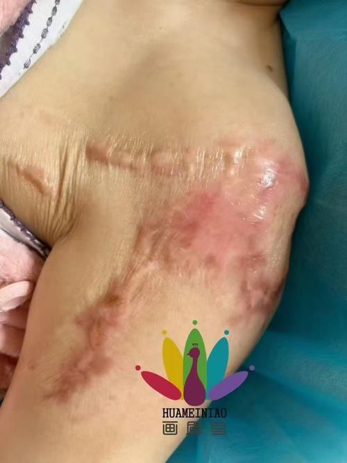 什么修复疤痕比较好