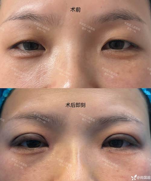 重睑什么意思