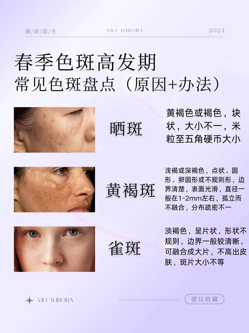 为什么会长妊娠斑
