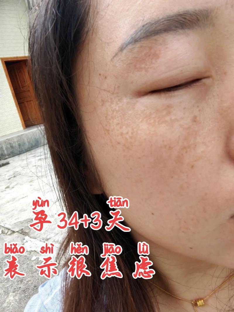 为什么会长妊娠斑
