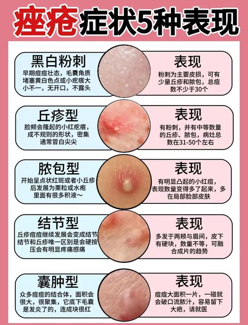座疮是什么引起的