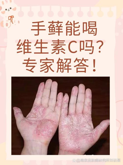 为什么会得手癣