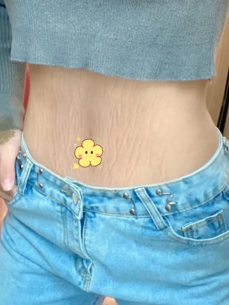 什么叫妊娠纹