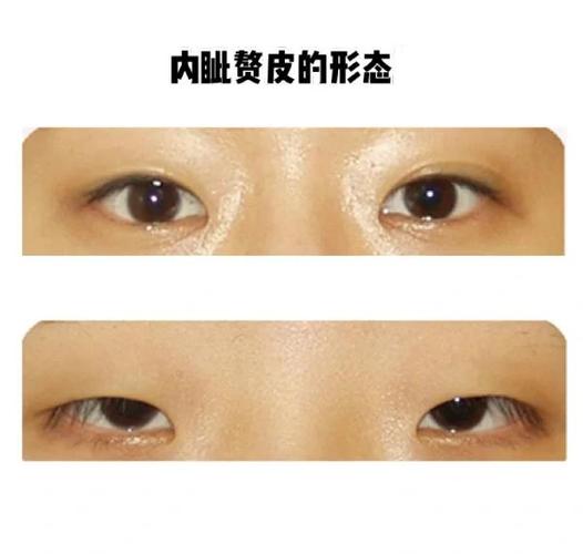 什么是内眦