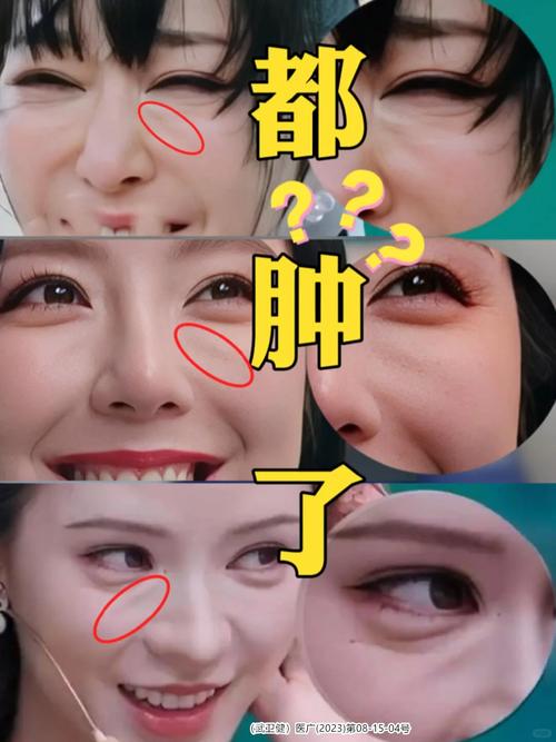 为什么泪沟