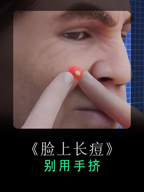 痘痘用什么挤