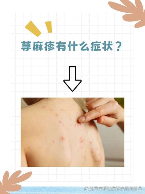 什么病会引起荨麻疹