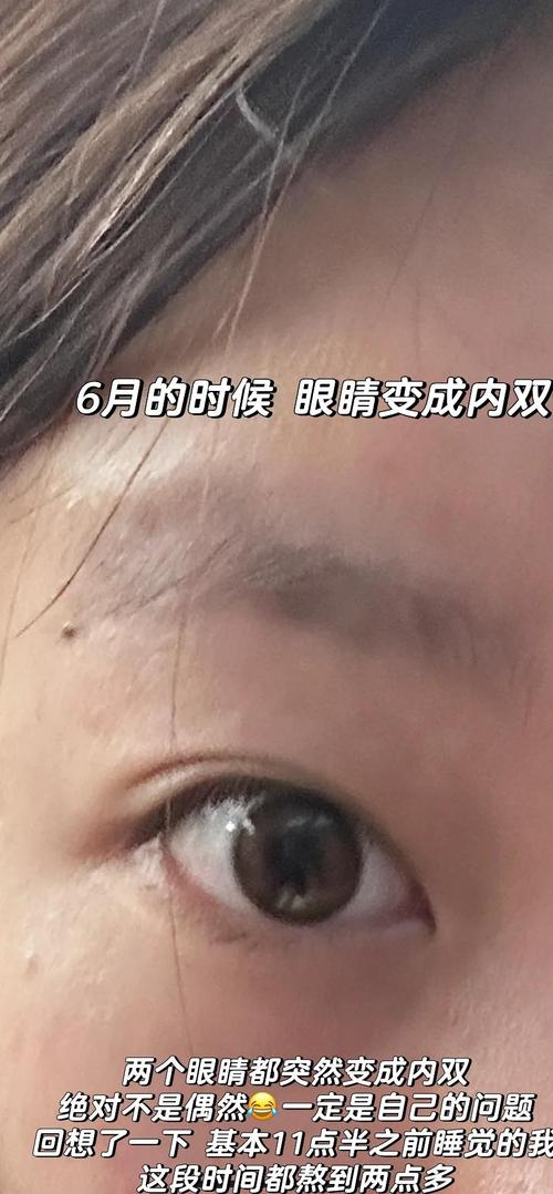 双眼皮为什么会消失