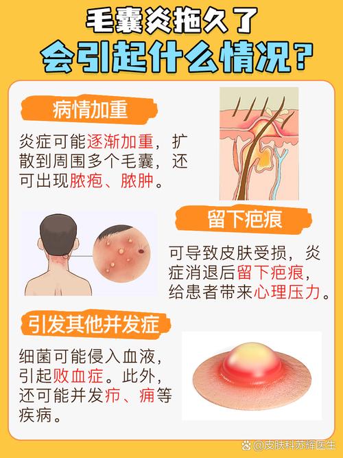 为什么会的毛囊炎