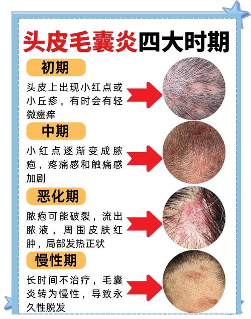 为什么会的毛囊炎