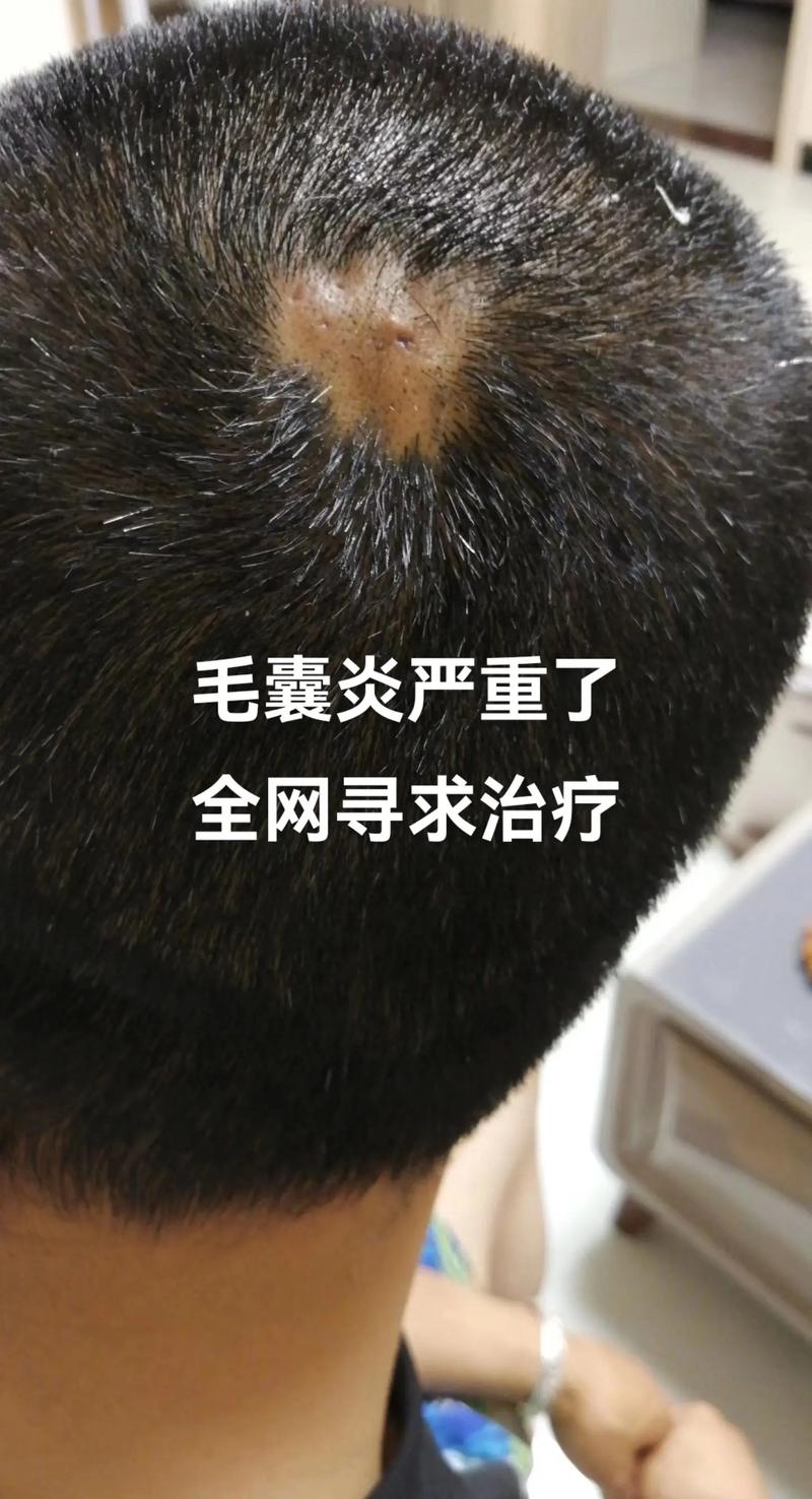 为什么会的毛囊炎
