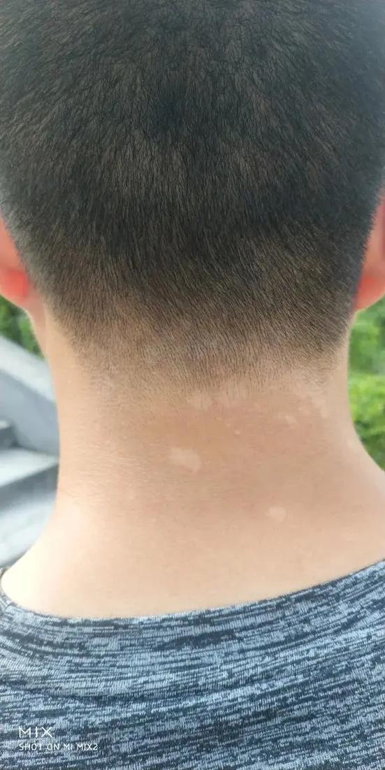 汗斑什么原因引起的