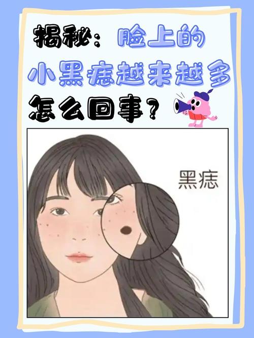 脸上为什么会长黑痣