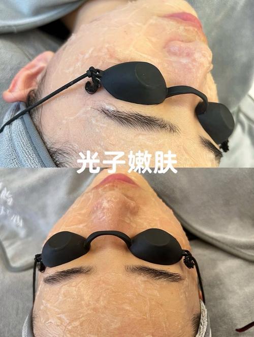 强脉冲光是什么