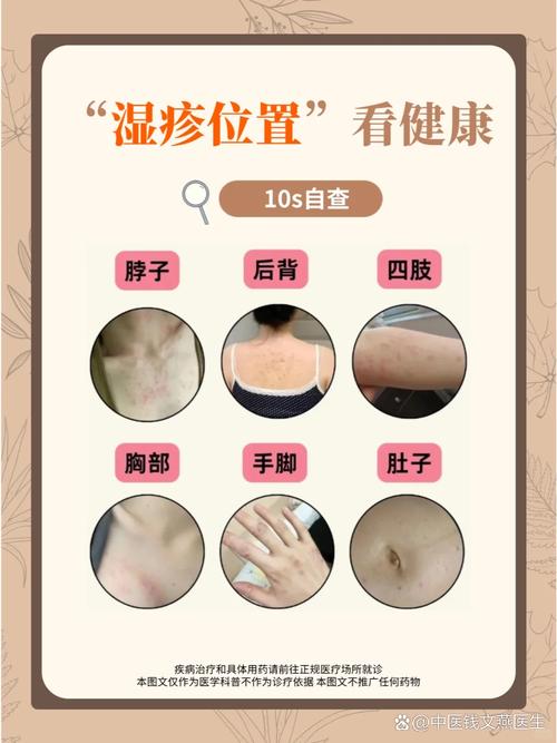 身上为什么会长湿疹