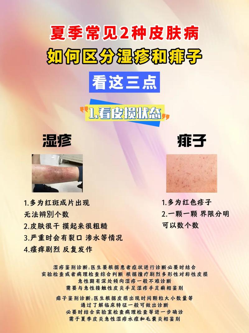 身上为什么会长湿疹
