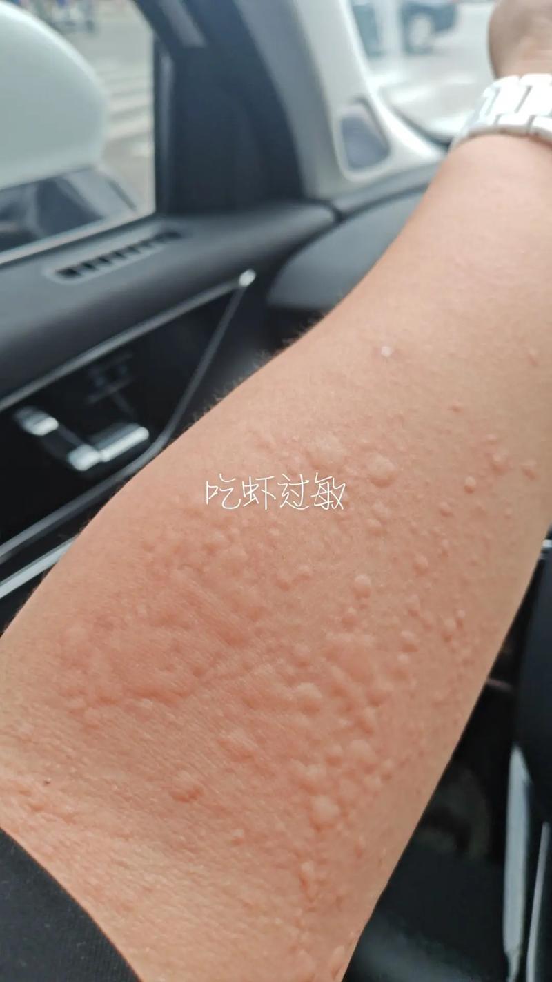 吃东西过敏什么症状