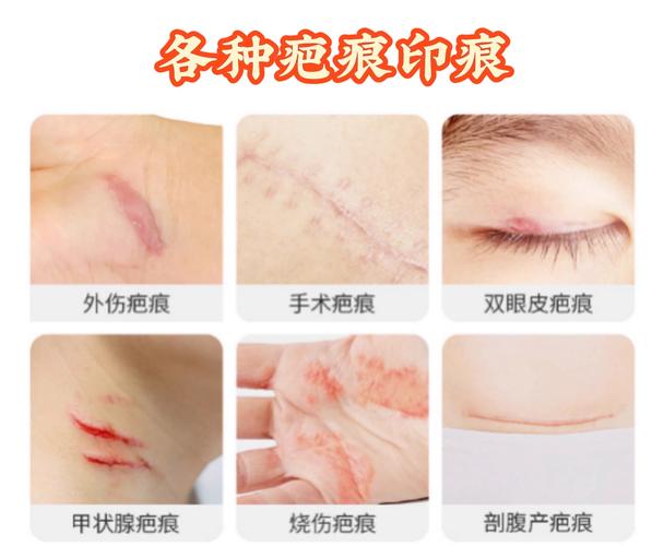 疤痕修复什么牌子好