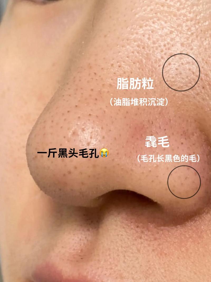 为什么鼻子上有黑头
