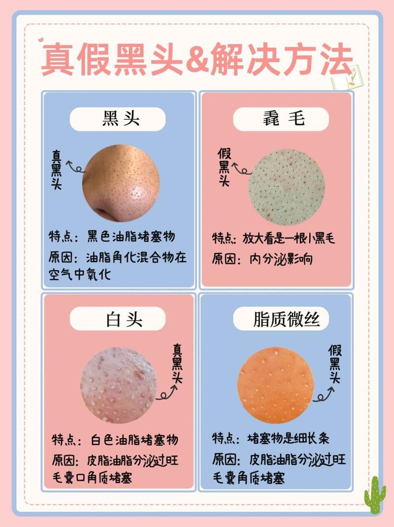 为什么鼻子上有黑头