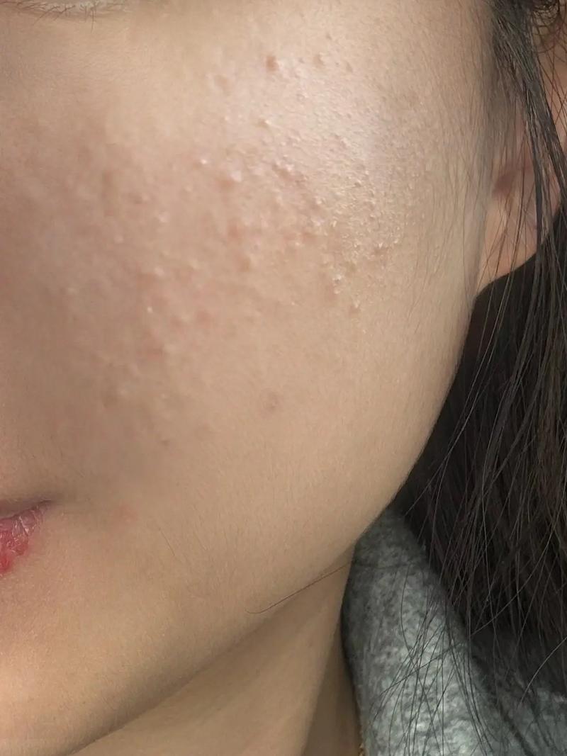 脸上为什么有闭口