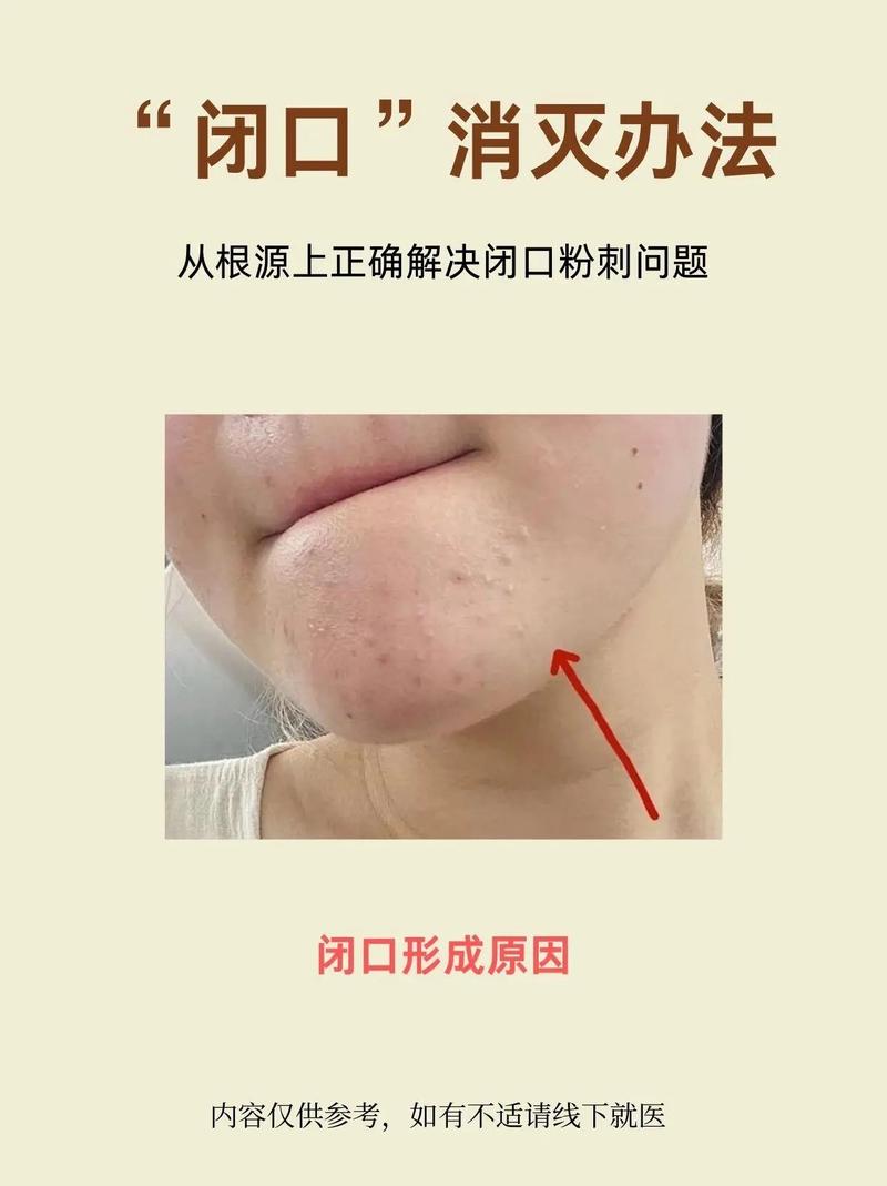 脸上为什么有闭口
