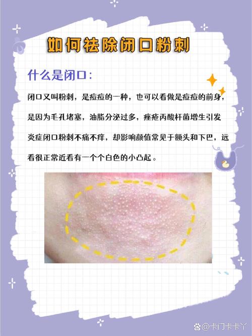 痘痘闭口什么意思