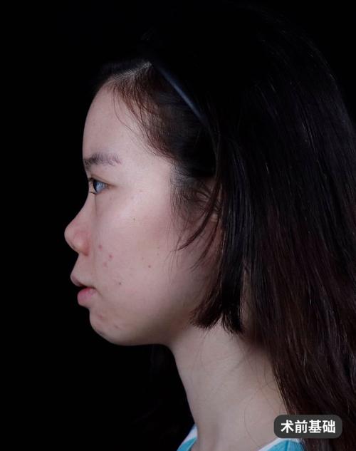 什么是短鼻子