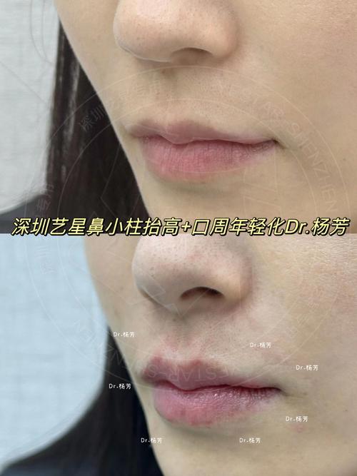 什么是短鼻子