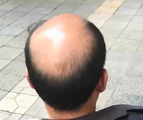 男人为什么会秃顶