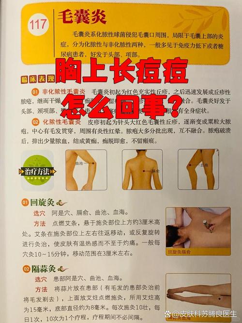 胸前为什么长痘痘