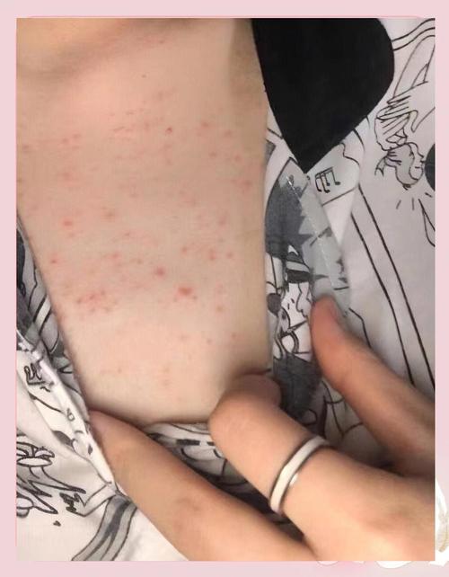 胸前为什么长痘痘