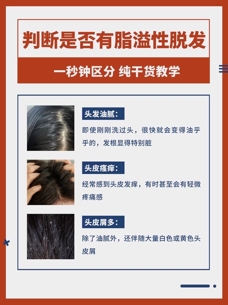 为什么会脂溢性脱发