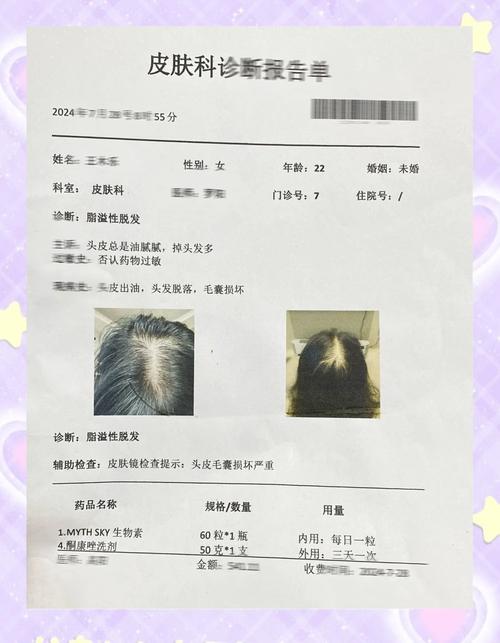 为什么会脂溢性脱发