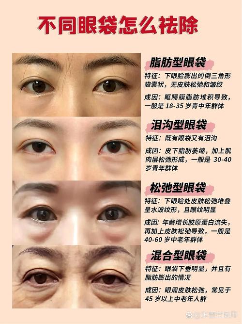 眼袋是什么形成的