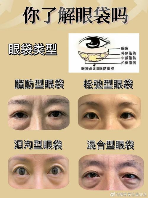 眼袋是什么形成的