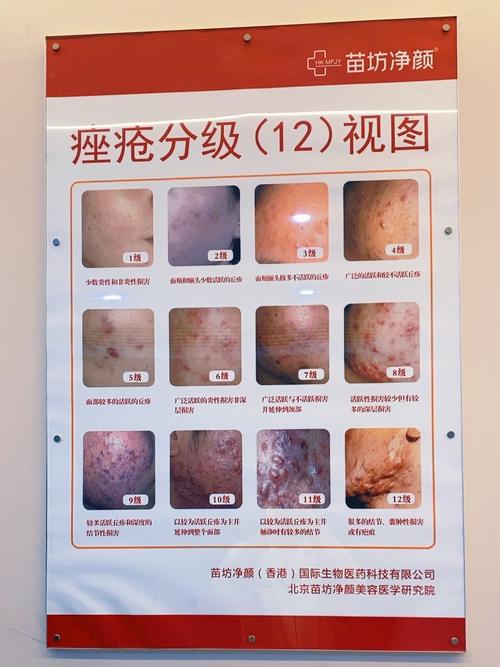 为什么要长青春痘