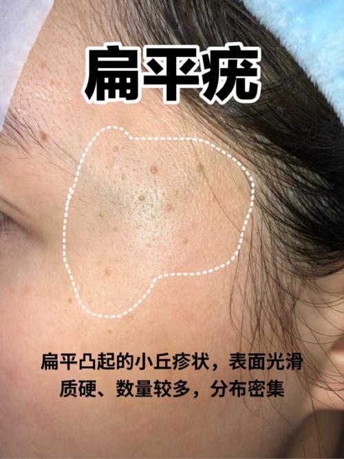 为什么会起扁平疣