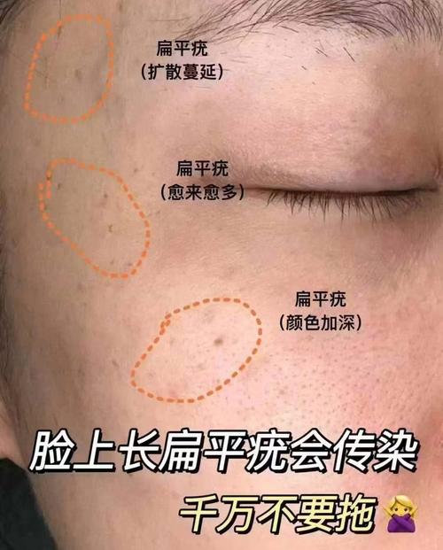 为什么会起扁平疣