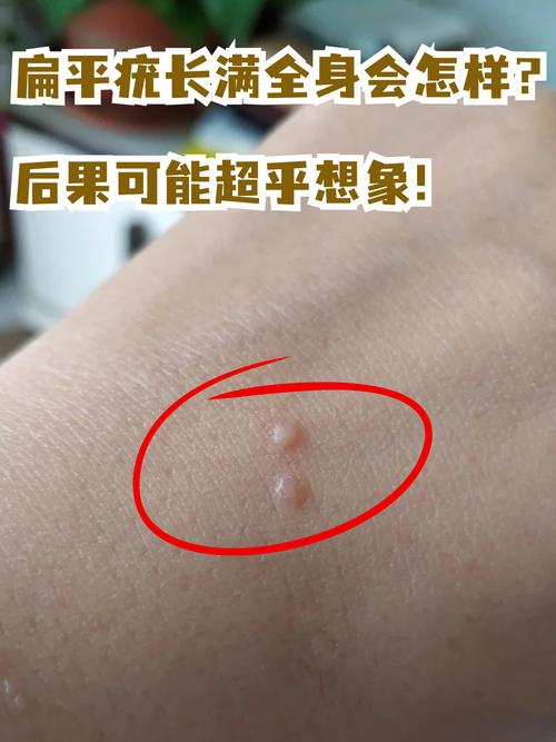 为什么会起扁平疣