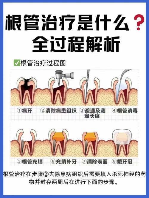 什么情况要根管治疗